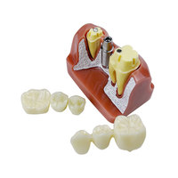 Modèle anatomique dentaire 4 fois plus grand pour implants, couronnes et bridges, en résine, pour l'analyse, la démonstration et la formation en dentisterie amovible