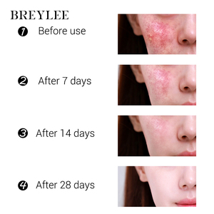 BREYLEE Private Label Tea Tree <span class=keywords><strong>Cream</strong></span> Crema facial para eliminar manchas oscuras, acné, espinillas, reparación de la piel - Product Image 6