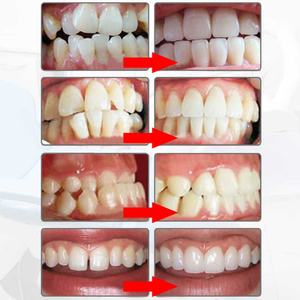 Nuevo Producto: Cómodos Accesorios de Blanqueamiento Dental de TPU para Uso Doméstico, Alineadores de <span class=keywords><strong>Dientes</strong></span> para Entrenamiento de Ortodoncia - Product Image 6