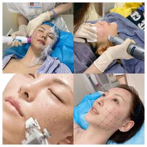 Ampoules Coréennes Exoglow à base de Poudre Lyophilisée de Cellules Souches Exoglow, EGF, et de Vesicules Extracellulaires pour la Régénération Cutanée et le Renforcement du Collagène - Product Image 3