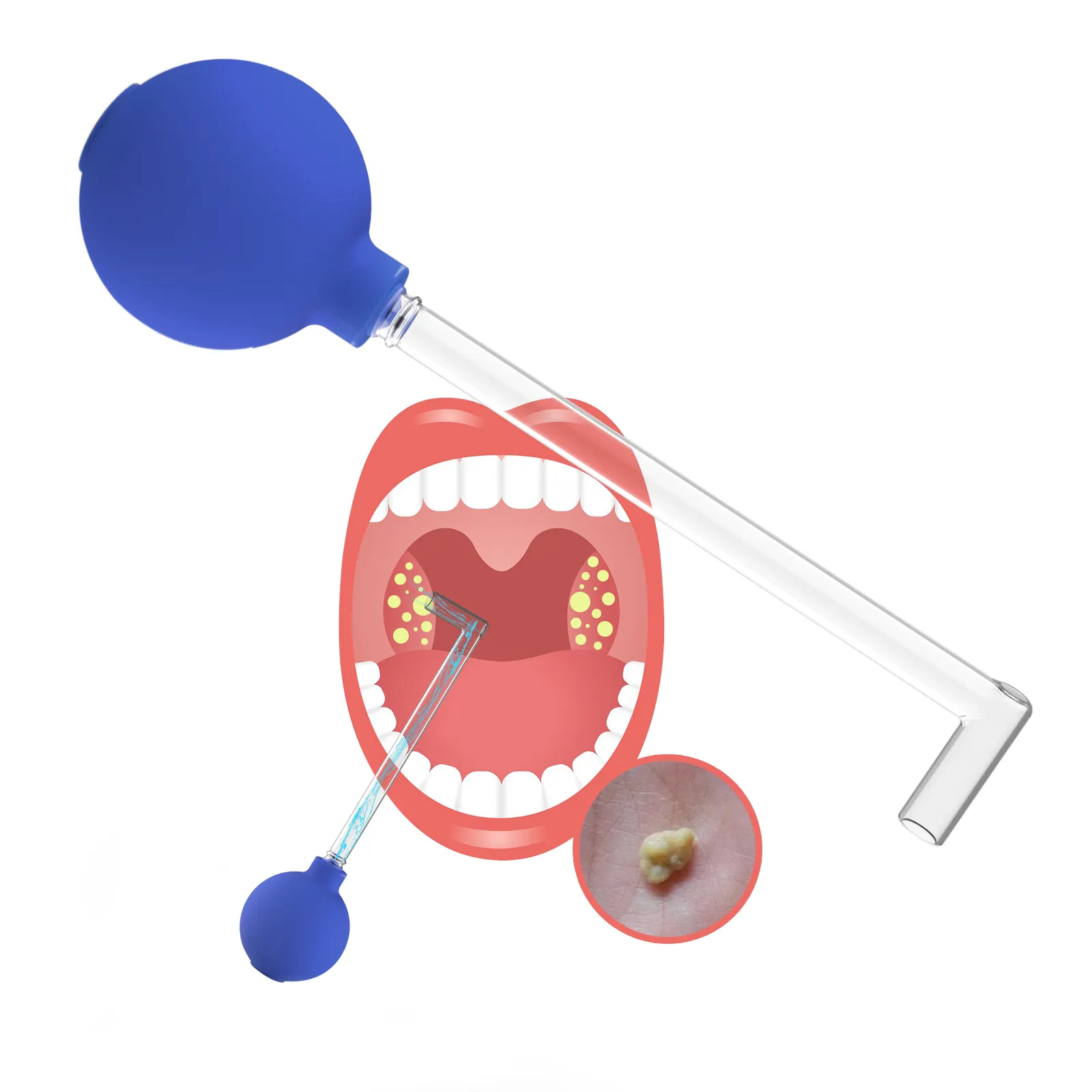 Tonsil pembersih mulut, alat penghilang batu gaya Manual pembersih PVC perawatan pembersih dengan bola penyedot
