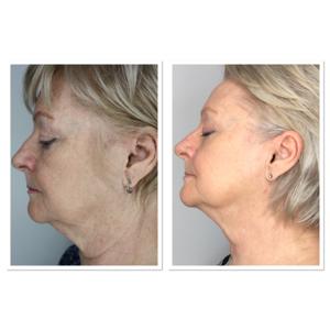 Dispositivo de Belleza HIFU RF Ultra 22D Max con Certificación CE, con Mango Multidimensional 13D para Lifting Facial y 18D RS para Terapia de Pérdida de Grasa - Product Image 6