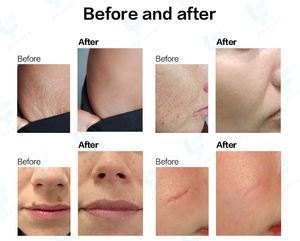 Laser frazionario <span class=keywords><strong>CO2</strong></span> portatile 10600nm Resurfacing Acne riparazione serraggio vaginale macchina Laser frazionaria <span class=keywords><strong>CO2</strong></span> prezzo di fabbrica - Product Image 6