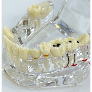 Modelo dental patológico transparente de boca completa para enseñanza médica, patología completa de los dientes, caries, odontología - Product Image 1