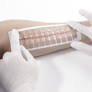 Dispositivo Médico Consumible, Cinta de Seda Médica, Dispositivo de Cierre de Heridas con Cierre Hidrocoloide Zipstitch - Product Image 1