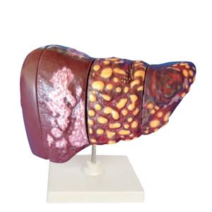 Yağlı karaciğer hasta eğitim malzemeleri karaciğer patolojisi modeli - Product Image 1