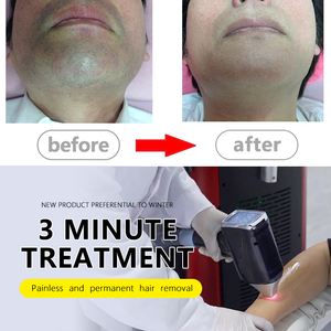 เครื่องเลเซอร์ไดโอ<span class=keywords><strong>ด</strong></span>กำจั<span class=keywords><strong>ด</strong></span>ขน1064Nm 4 Wavelength755Nm เครื่องกำจัดขนเลเซอร์ไ<span class=keywords><strong>ด</strong></span>โอ<span class=keywords><strong>ด</strong></span>808nm ใช้เทคโนโลยีทางการแพทย์รับประกัน2<span class=keywords><strong>ปี</strong></span> - Product Image 3