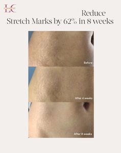 OEM Natural nutriente previene la crema per le smagliature, Set di siero per la pancia dorata per la gravidanza, le donne dopo il parto - Product Image 2