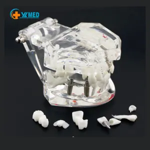 Modelo de Restauración Dental transparente, para ciencia médica, desmontable, implante, pantalla de uñas, comunicación para enseñanza