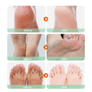 UUKKG Meilleure Vente Masque Exfoliant pour les Pieds, <span class=keywords><strong>Gommage</strong></span> Pédicure, Chaussettes Spa, Masque Peeling pour les Pieds, Soin des Talons, Élimine les Peaux Mortes, Hydratant - Product Image 4