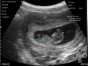 Máy Quét Siêu Âm USB WIFI Siêu Âm Cầm Tay Không Dây Đầu Dò Tuyến Tính - Product Image 6