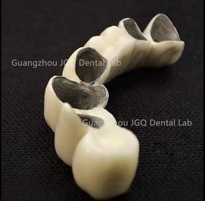 พอร์ซเลนหลอมรวมกับฟันปลอมโลหะ (โลหะผสมโครเมี่ยมโคบอลต์) - Product Image 5