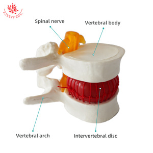 FRT039, un modelo ampliado de la columna lumbar, se utiliza para la enseñanza y demostración de la hernia de disco lumbar. - Product Image 1