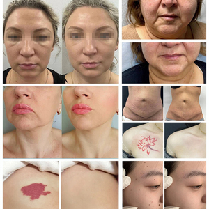 Machine laser Nd Yag Q-Switched picoseconde pour l'élimination des tatouages et des pigments - Product Image 6