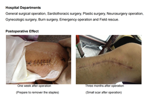 Phẫu thuật mặt hàng chủ lực da dùng một lần <span class=keywords><strong>Stapler</strong></span> và thấm sử dụng duy nhất hoạt động tự động tuyến tính đôi tay chất lượng cao CE AP - Product Image 6