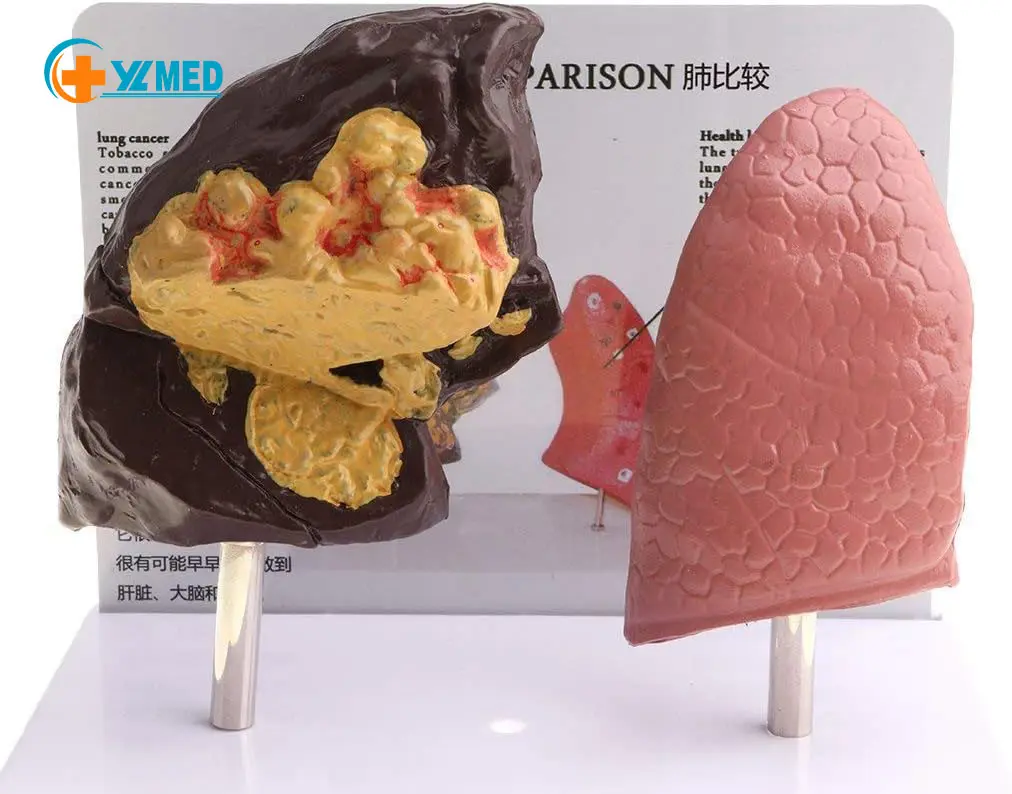 Modelo de Contraste Pulmonar Ciências Médicas Equipamento de Laboratório de Saúde e Patologia Modelo Anatômico recursos de ensino