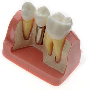 Gelsonlab HSDT-M3 4 Volte <span class=keywords><strong>Implant</strong></span> Denti Modello Dentale Modello di Impianto Analisi <span class=keywords><strong>Crown</strong></span> Ponte Dimostrazione Denti Modello per la Formazione - Product Image 6