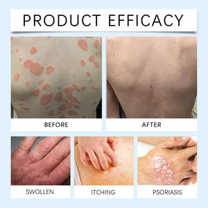 VENENO DE ABEJA Spray Herbal para el Tratamiento de la Psoriasis y el Eccema, Pie de Atleta, Tiña de las Manos, Dermatitis, Antibacteriano, Beriberi, Reparación Anti-picazón - Product Image 3