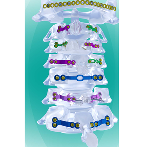Titanium Wervelkolom Chirurgische Systemen Posterieure Cervicale Laminoplastiek Orthopedische Chirurgie Implantaatklasse Iii Ce Gecertificeerd - Product Image 1