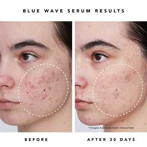 Suero Facial de Ácido Salicílico de Marca Blanca para Limpieza Profunda de Poros, Reparación de la <span class=keywords><strong>Piel</strong></span> y Tratamiento Equilibrante para Todo Tipo de <span class=keywords><strong>Piel</strong></span> - Product Image 6