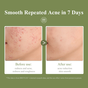 BREYLEE ance products con almohadillas para mascarillas <span class=keywords><strong>de</strong></span> suero <span class=keywords><strong>de</strong></span> ácido salicílico - Product Image 2