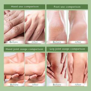 最高のアラントイン手と足のホワイトニングクリーム除去カルスひびの入ったかかとの修理スキンケア - Product Image 2