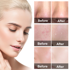 VOGSIG नाक पैच ब्लैकहैड हटानेवाला स्ट्रिप्स और मिट्टी कीचड़ हरी चाय तेल नियंत्रण सफाई मुखौटा छड़ी ठोस चेहरे का मुखौटा - Product Image 2