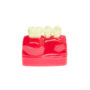 Modèle dentaire, modèle pédagogique buccal, modèle d'implant dentaire détachable, modèle de communication médecin-patient, modèle de soins dentaires - Product Image 2
