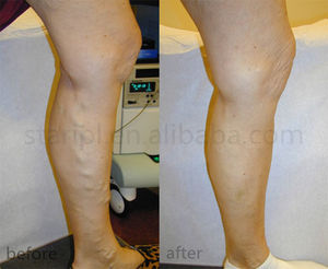 Traitement au laser pour les varices EVLT 1470 nm du fabricant, ablation endoveineuse au laser 47W, <span class=keywords><strong>appareil</strong></span> mini-invasif - Product Image 6