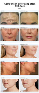 Appareil de lifting du visage, stimulation du visage, appareil V-line, anti-âge, élimination des rides, appareil pour les paupières - Product Image 6