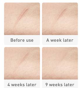 Gel de suppression des cicatrices et des marques d'acné TCM Améliorant <span class=keywords><strong>la</strong></span> vitalité cellulaire Lissant <span class=keywords><strong>la</strong></span> peau Peau endommagée Blanchiment Crème réparatrice - Product Image 4