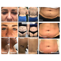 Prezzo di fabbrica Scrub facciale macchine a microcorrente lifting Rf ultrasuoni macchina di bellezza
