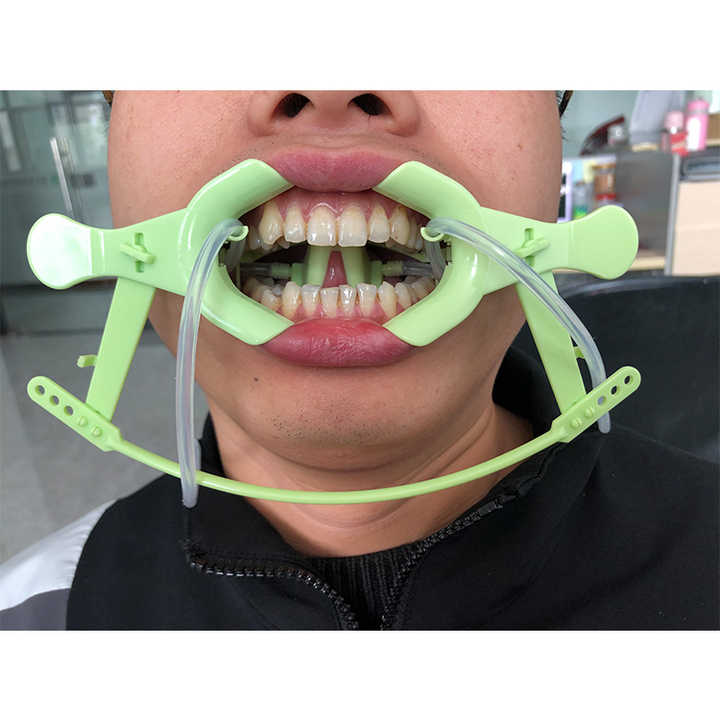 YILON 　Cut out cheek op YILON Cut out cheek op 6 Minnesota Cheek Retractor with