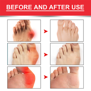 EELHOE crème pour oignons amélioration de la flexibilité articulaire œdème des kystes élimination du dos cou <span class=keywords><strong>genou</strong></span> main pieds crème anti-douleur aux jambes - Product Image 6