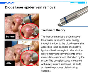 Mesin Pabrik Asli 980 Nm Diode Laser Terapi Penghapusan Vaskular 980nm untuk Pengobatan Varises, Jamur Kuku, dan Perawatan Gigi - Product Image 2