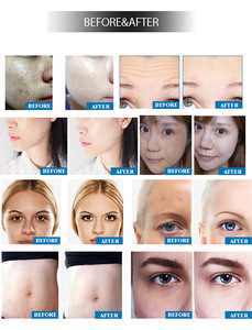 Appareil de nettoyage du visage avec écran tactile 10,4'' LNKETS, machine de mésothérapie approuvée CE avec brosse de nettoyage - Product Image 5