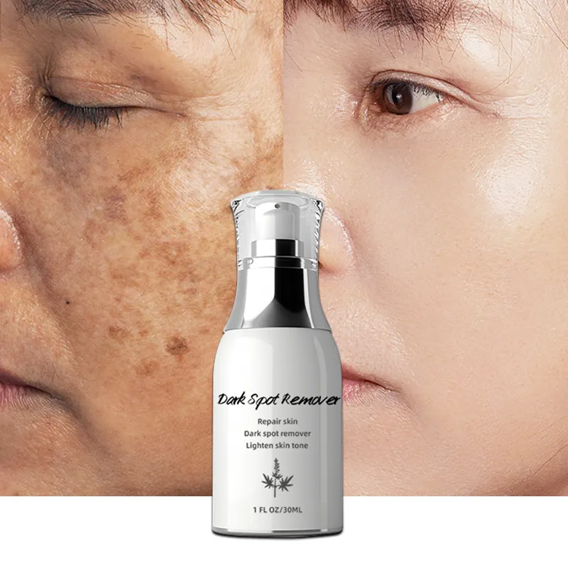 Bio-Maiselsäure und Salicylsäure Gesichtsserum Hautdunkelflecken-Korrektor Haut-Dunkelflecken-Entferner für Gesicht und Körper