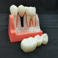 Modèle d'implant dentaire, couronne, pont, modèle amovible, modèle de dents en porcelaine, modèle de démonstration dentaire pour l'enseignement des dentistes