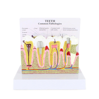 Modèle de pathologie dentaire Modèles de dents dentaires Modèle d'anatomie de la carie en plastique Équipement éducatif détachable médical Formation des dents