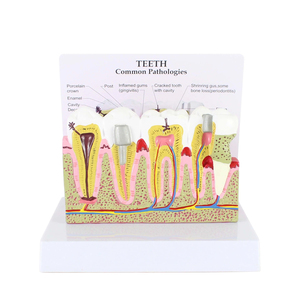 Modèle de pathologie dentaire Modèles de dents dentaires Modèle d'anatomie de la carie en plastique Équipement éducatif détachable médical Formation des dents - Product Image 1