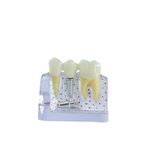 Modelo de Implante Dental de Plástico para Educación Dental, 4 Unidades, Multiusos, Accesorios para Blanqueamiento Dental - Product Image 4