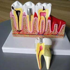 Fabriek direct dental pulp ziekte model 2 delen van medische wetenschap onderwerp