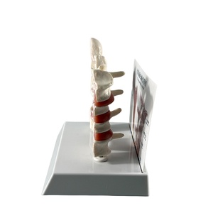 Modèle de pathologie de l'ostéoporose Modèle d'ostéoporose de vertèbre humaine Ensemble de modèles osseux ostéoporotiques - Product Image 3