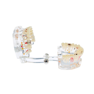 Modelo patológico de boca completa con 32 dientes; modelo dental patológico completo; modelo dental desmontable; restauración de implantes - Product Image 3