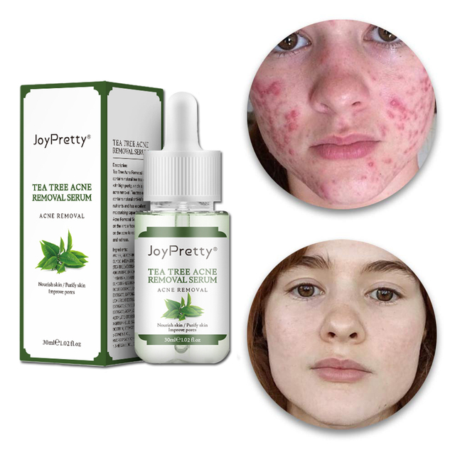 Wholesale Korean Organic Anti Age Acne Herbal Treatment Pimple Remover Skin Care Tea Tree Whitening Serum for Face