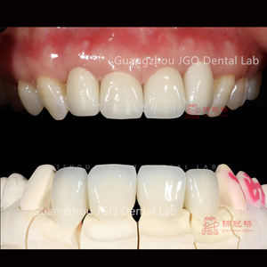 Couronne et ponts personnalisables en céramique de porcelaine à haute résistance de zircone pour les <span class=keywords><strong>dents</strong></span> antérieures et postérieures - Product Image 4