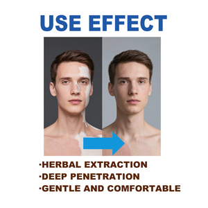 Crème de soin corporel en gros OEM/ODM pour la réparation du <span class=keywords><strong>vitiligo</strong></span>, tube de 20g, adapté aux adultes - Product Image 4