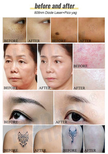 Máquina Depiladora para Mujer, Alta Calidad, Portátil, 808nm, OEM ODM, Belleza y Cuidado Personal, Nueva Tecnología - Product Image 6