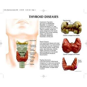 Modello di patologia tiroidea endocrinologia modello di visualizzazione della malattia della tiroide venduto come modello anatomico di scienza medica - Product Image 4