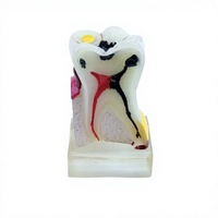 Modelo Anatómico de Molar Patológico Dental de 4 Veces el Tamaño Real, Simulación de Perfil de Caries, Modelo de Enseñanza para Entrenamiento Dental